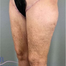 Thigh Lift Before & After Patient #247