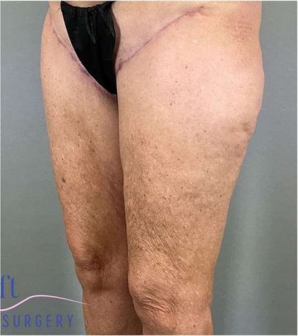 Thigh Lift Before & After Patient #247