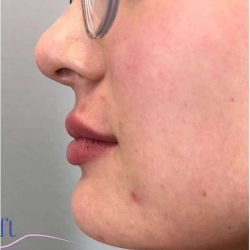 Injectables&Fillers Before & After Patient #130