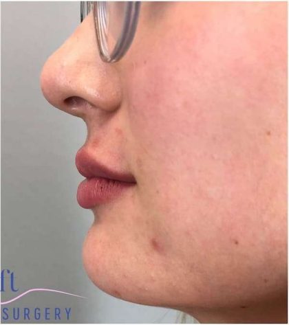 Injectables&Fillers Before & After Patient #130