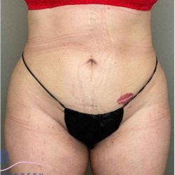 Bodytite Before & After Patient #258
