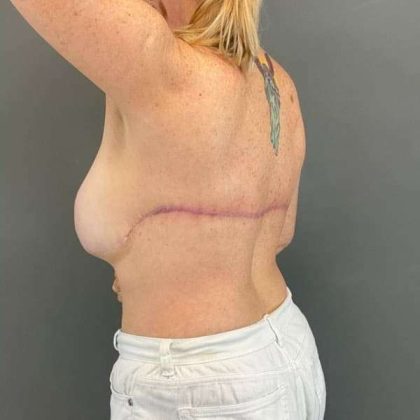 Back Lift Before & After Patient #287
