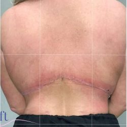 Back Lift Before & After Patient #292