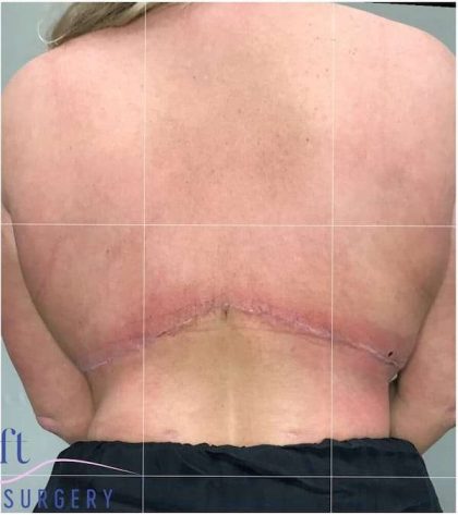 Back Lift Before & After Patient #292