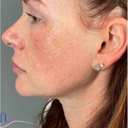 Injectables&Fillers Before & After Patient #118
