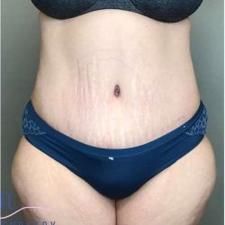 Tummy Tuck Before & After Patient #314