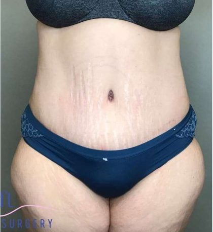 Tummy Tuck Before & After Patient #314
