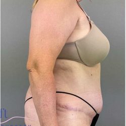 Tummy Tuck Before & After Patient #325