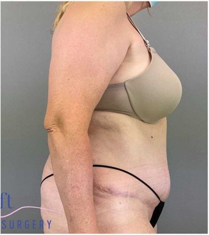 Tummy Tuck Before & After Patient #325