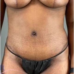 Tummy Tuck Before & After Patient #332