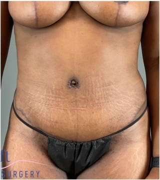 Tummy Tuck Before & After Patient #332