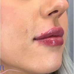 Injectables&Fillers Before & After Patient #135