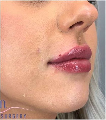 Injectables&Fillers Before & After Patient #135