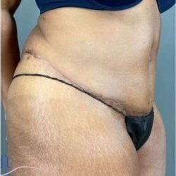 Tummy Tuck Before & After Patient #346