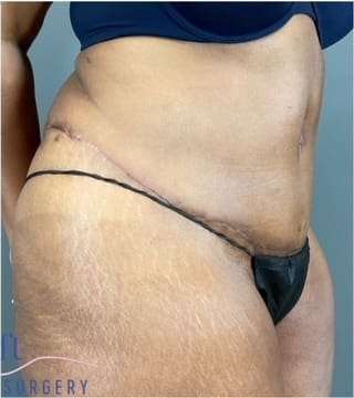 Tummy Tuck Before & After Patient #346