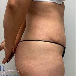 Tummy Tuck Before & After Patient #357
