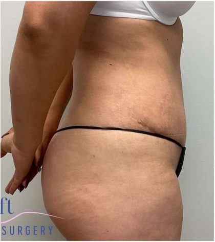 Tummy Tuck Before & After Patient #357