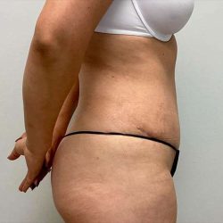 Tummy Tuck Before & After Patient #379