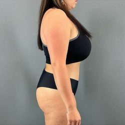 Tummy Tuck Before & After Patient #390