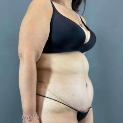 Tummy Tuck Before & After Patient #401