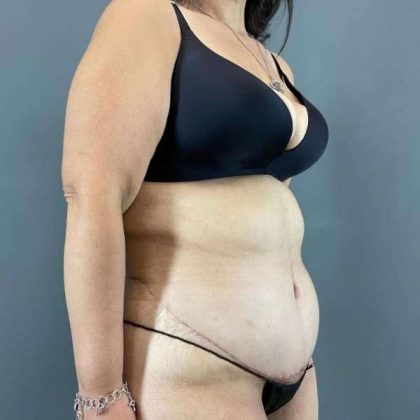 Tummy Tuck Before & After Patient #401