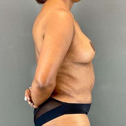 Tummy Tuck Before & After Patient #412