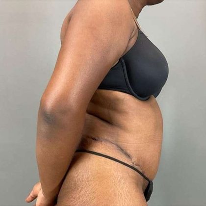 Tummy Tuck Before & After Patient #423