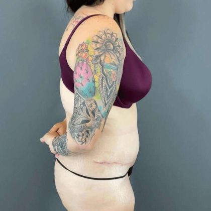 Tummy Tuck Before & After Patient #434