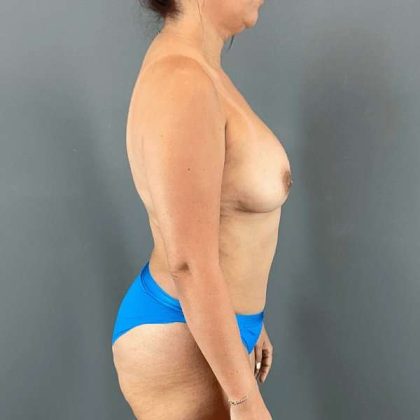Tummy Tuck Before & After Patient #445