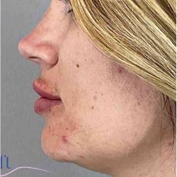 Injectables&Fillers Before & After Patient #140