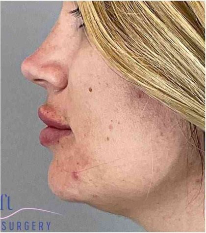 Injectables&Fillers Before & After Patient #140
