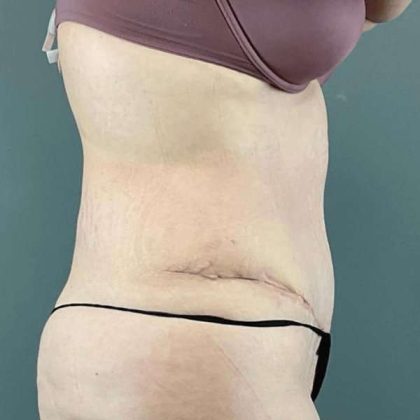 Tummy Tuck Before & After Patient #476