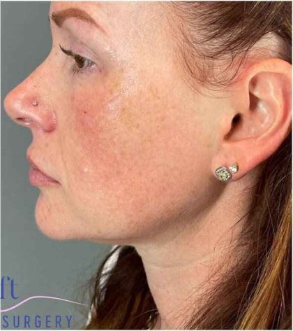 Injectables&Fillers Before & After Patient #118