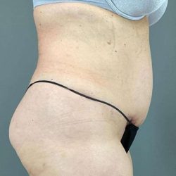 Tummy Tuck Before & After Patient #498