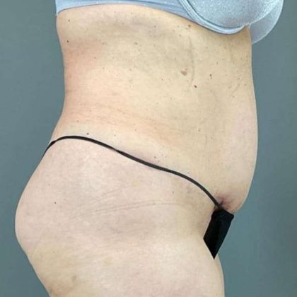 Tummy Tuck Before & After Patient #498