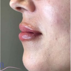 Injectables&Fillers Before & After Patient #145