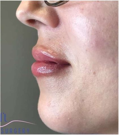 Injectables&Fillers Before & After Patient #145