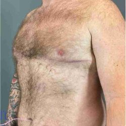 Gynecomastia Before & After Patient #560