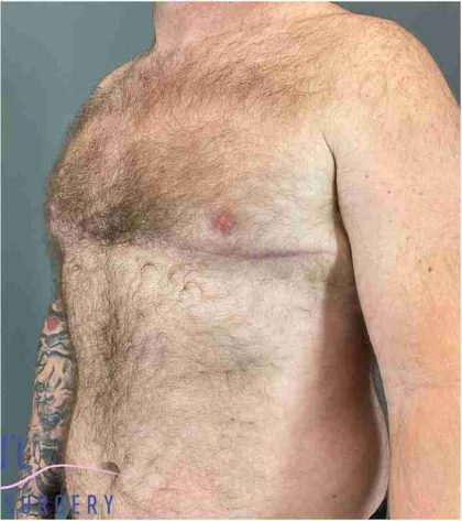 Gynecomastia Before & After Patient #560