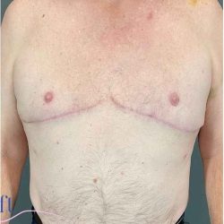 Gynecomastia Before & After Patient #571
