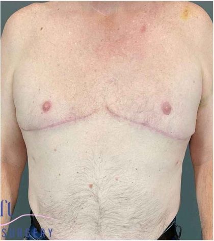 Gynecomastia Before & After Patient #571