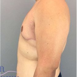 Gynecomastia Before & After Patient #582