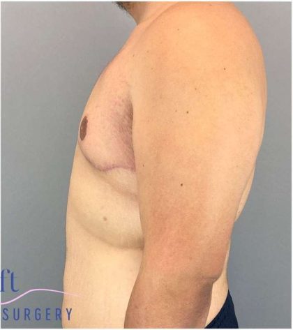 Gynecomastia Before & After Patient #582