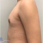 Gynecomastia Before & After Patient #593