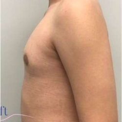 Gynecomastia Before & After Patient #593