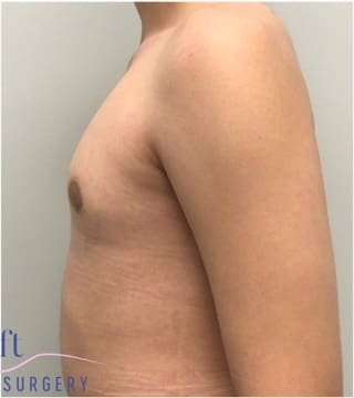 Gynecomastia Before & After Patient #593