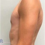 Gynecomastia Before & After Patient #604