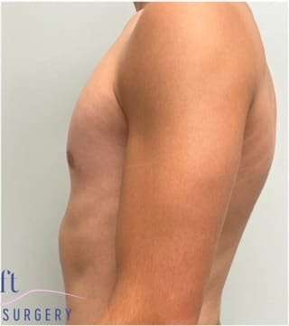 Gynecomastia Before & After Patient #604