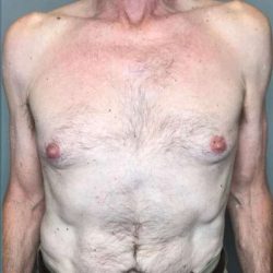 Gynecomastia Before & After Patient #611