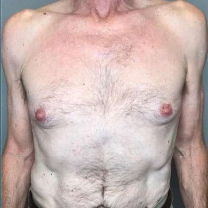 Gynecomastia Before & After Patient #611